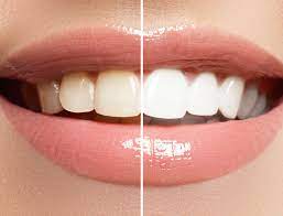 SmileKit No More Yellow Stains,( imported From USA )