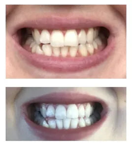 SmileKit No More Yellow Stains,( imported From USA )